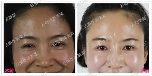 大中小分子玻尿酸有什么區(qū)別，法令紋又是用的什么