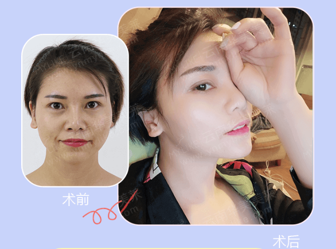 大中小分子玻尿酸有什么區(qū)別，法令紋又是用的什么
