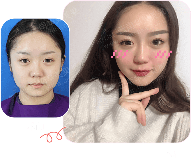 選擇玻尿酸填充面部有副作用嗎，會(huì)不會(huì)凹凸不平?