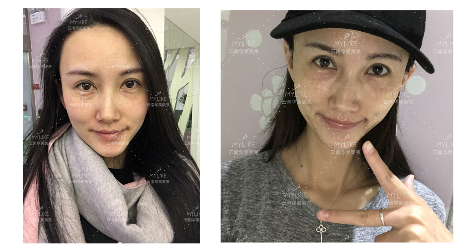 2018年“魅力絲路 時尚昆明”車模大賽勝者必要做的醫(yī)美項目！！美萊雙十一get好物推薦