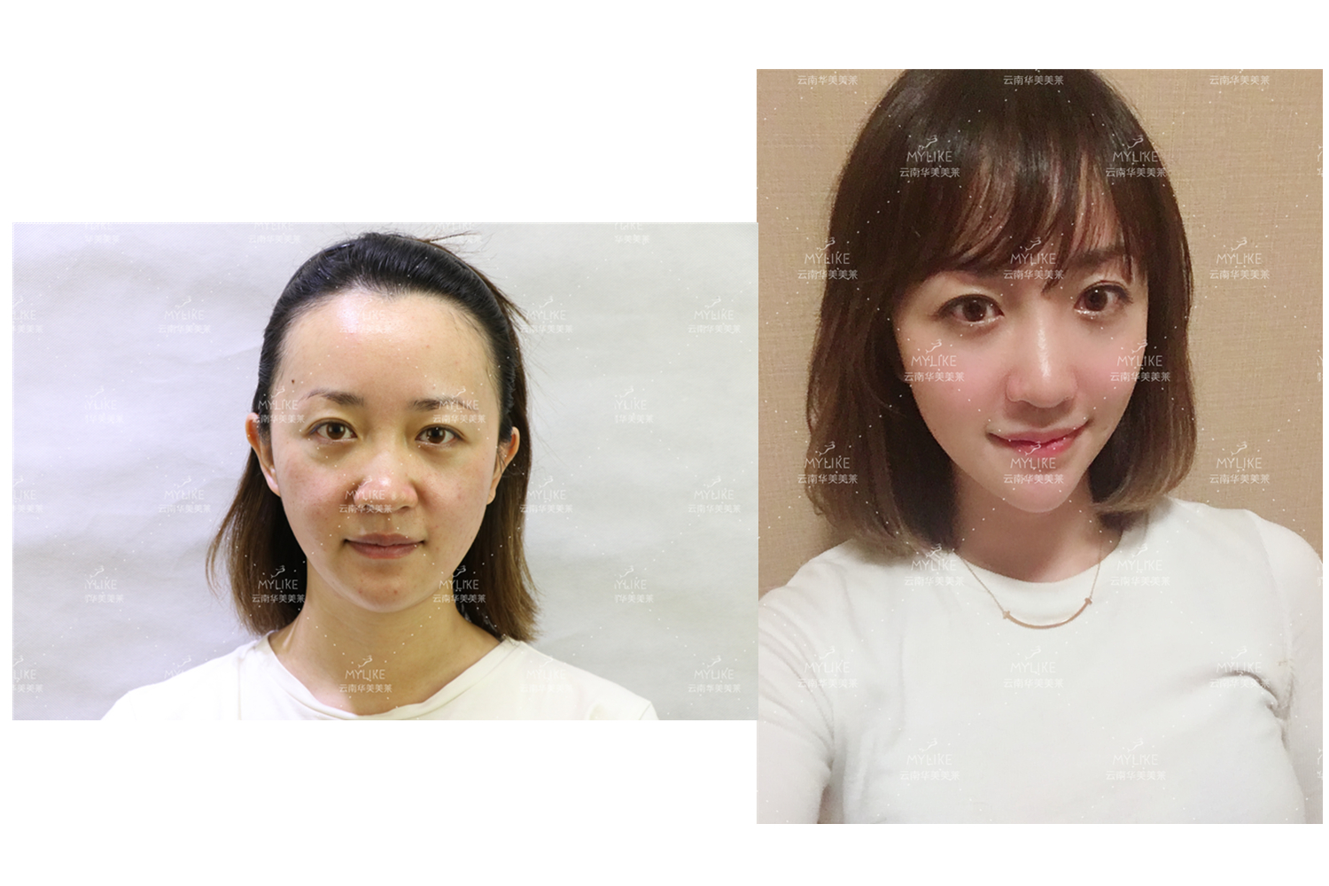 出演電視劇《官渡人家》的小姐姐必做的醫(yī)美項(xiàng)目?。∶廊R雙十一get好物推薦
