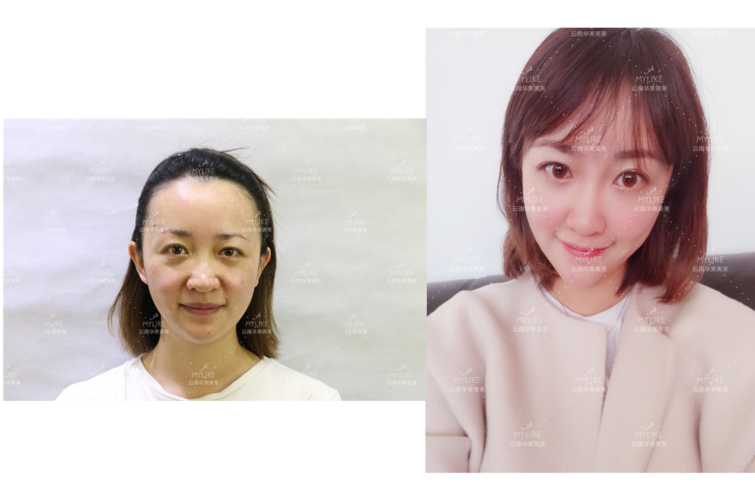 出演電視劇《官渡人家》的小姐姐必做的醫(yī)美項(xiàng)目??！美萊雙十一get好物推薦