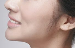 假體墊下巴術(shù)后的護(hù)理事項有哪些