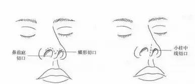 廈門隆鼻后假體一定要取出嗎？