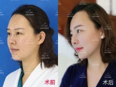 西安注射玻尿酸隆下巴安全嗎，會(huì)不會(huì)有副作用
