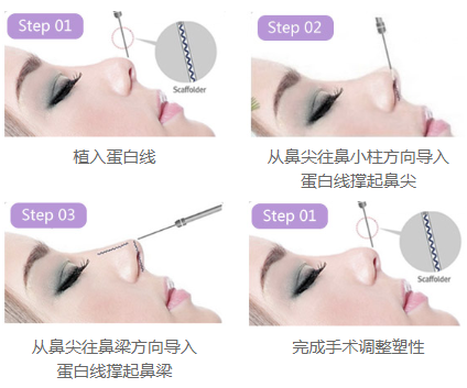 什么人適合做*雕鼻？鼻頭大可以做嗎