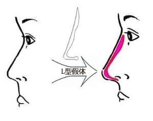 深圳假體隆鼻失敗修復(fù)多少錢？