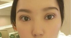 深圳做雙眼皮修復(fù)是不是很貴？