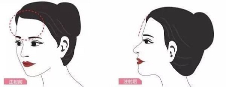 成都做自體脂肪面部填充可以維持十年嗎？