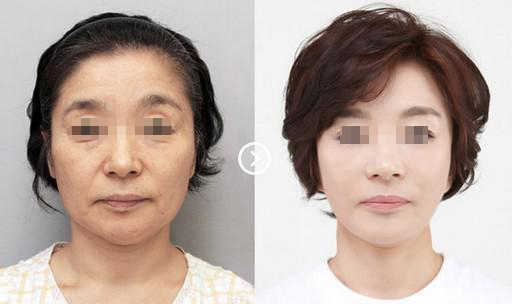 深圳激光除皺價格多少錢？能?徹底的去除嗎?
