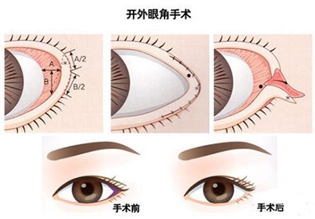 開(kāi)眼角手術(shù)