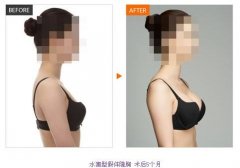假體隆胸價格是多少？