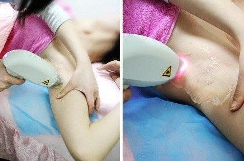 激光脫毛疼嗎？