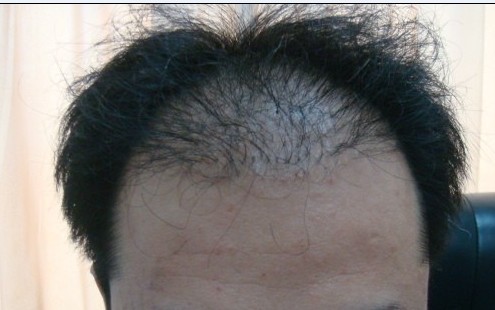 植發(fā)的術后護理要注意什么？