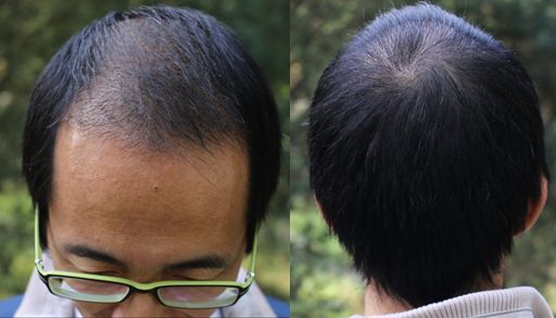 頭發(fā)種植后怎么護(hù)理？