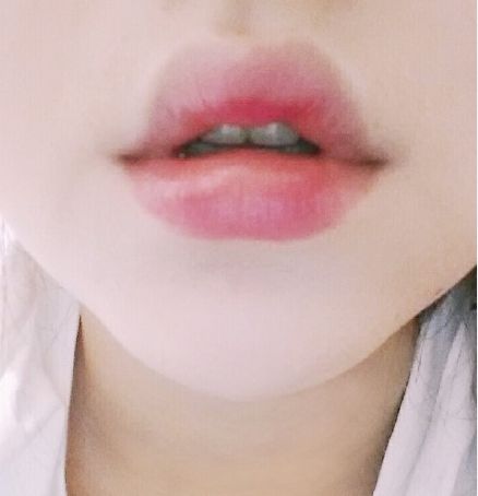 用玻尿酸豐唇后怎么護理？