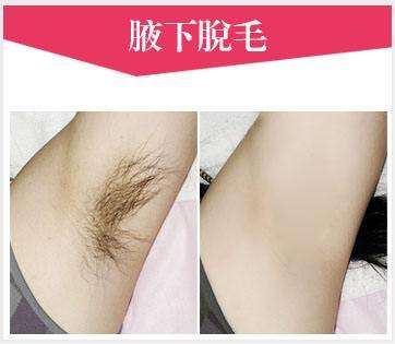 冰點激光脫毛效果好嗎？