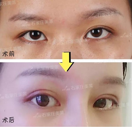 明星的眼和鼻，術(shù)后半個(gè)月Get專業(yè)混血臉！可萌可酷美翻了~