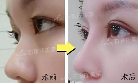 術(shù)后半個(gè)月Get專業(yè)混血臉！可萌可酷美翻了~