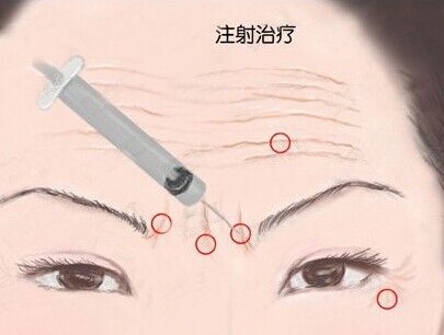 寧波注射除皺有哪些優(yōu)勢？