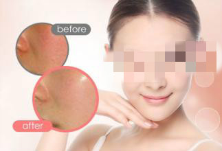 重慶激光美白費(fèi)用多少？