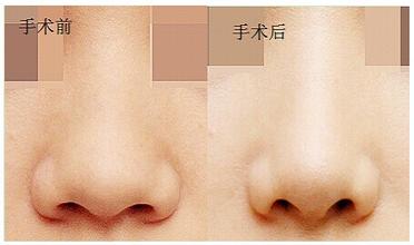 鼻孔縮小術要多少錢？