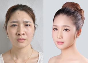 鼻孔縮小術要多少錢？