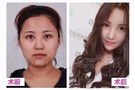 鼻子有這2個bug，影響顏值又顯老！