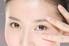 開內(nèi)眼角多久可以恢復？