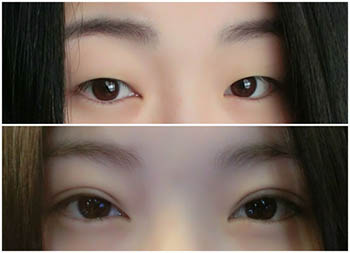 微創(chuàng)雙眼皮手術(shù)要多少錢(qián)？