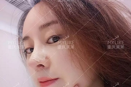 “鼻綜合”后假又歪，還攣縮？鼻修復(fù)還原自然生態(tài)美鼻