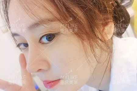 “鼻綜合”后假又歪，還攣縮？鼻修復(fù)還原自然生態(tài)美鼻