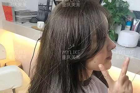 “鼻綜合”后假又歪，還攣縮？鼻修復(fù)還原自然生態(tài)美鼻