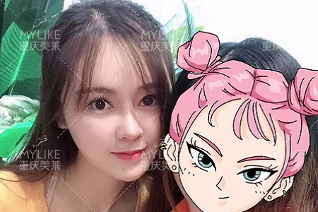 “鼻綜合”后假又歪，還攣縮？鼻修復(fù)還原自然生態(tài)美鼻