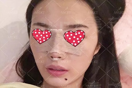 顏值：隆了個鼻子，男朋友說像換了一個女朋友