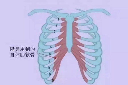 什么，隆鼻方式竟然有這么多種？