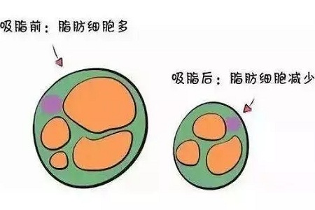 關(guān)于吸脂那些不能說的秘密，今天要在這里一次說完！