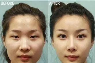 雙眼皮+開眼角為什么是較佳拍檔，一分鐘帶你看懂！