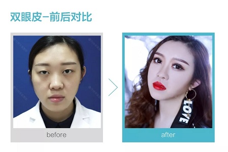 做了雙眼皮，醫(yī)師為什么建議要多睜眼？
