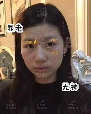 市面上五花八門(mén)的雙眼皮項(xiàng)目，如何有效找到你的菜？