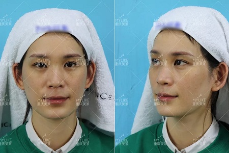 那個斑點女孩后來怎么樣了？