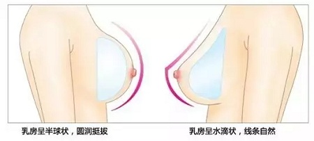 要不要隆胸，你對豐胸手術(shù)了解多少？