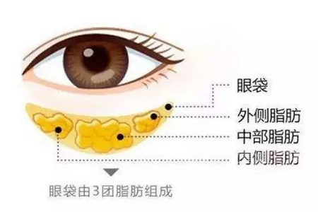 去掉眼袋，刻不容緩，別等又大又松弛才做