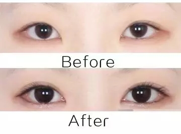 美萊實(shí)驗(yàn)室：開(kāi)眼角就是醫(yī)師想多收錢(qián)？