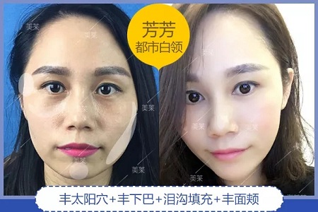 噓！你想不想隨心所欲的美？選擇玻尿酸吧！
