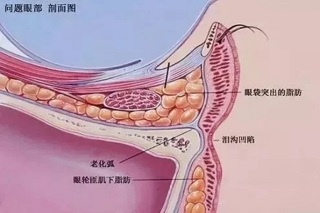 顯老淚溝，你還要任其放肆嗎？