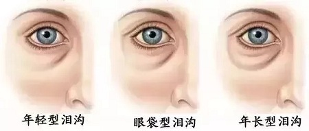 顯老淚溝，你還要任其放肆嗎？