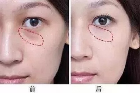 顯老淚溝，你還要任其放肆嗎？