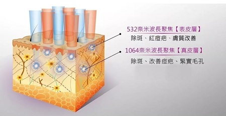 超皮秒激光祛斑，實(shí)力素顏，不加“斑”