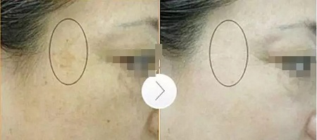 超皮秒激光祛斑，實(shí)力素顏，不加“斑”